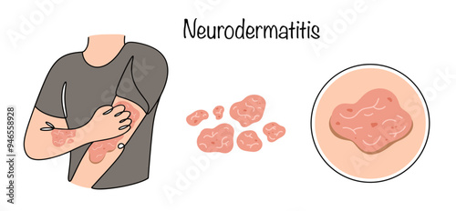 Neurodermatitis