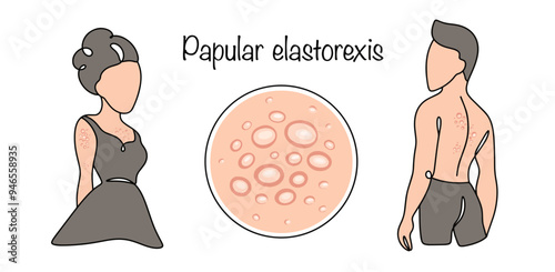 Papular elastorexis