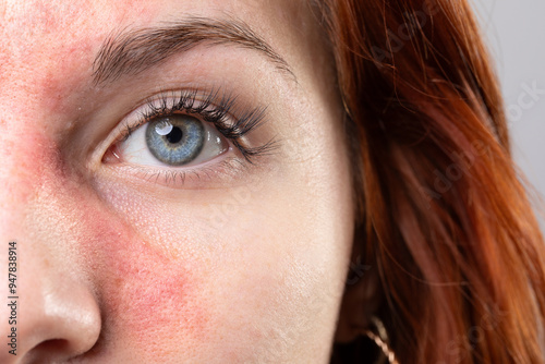 Young woman showing symptoms of rosacea on her face photo