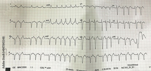 Foto Atrial Fibrillation, AF is often described as having 'rapid ventricular response