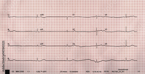 Sinus Bradycardia heart rate of < 60 bpm higher-degree AV block or CHB or SSS 