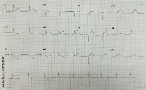 12 Lead ECG showing ST segment elevation in lead I aVL V2-V6 represents Acute anterior MI