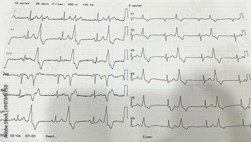 Premature Ventricular Complex (PVC) , SR with PVC ,Ventricular Arrhythmias photo