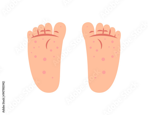 illustration of two soles of feet covered with rashes and wounds. red spots on feet. symptoms of Singapore flu or chicken pox. foot and skin diseases. health problems. flat style design. element