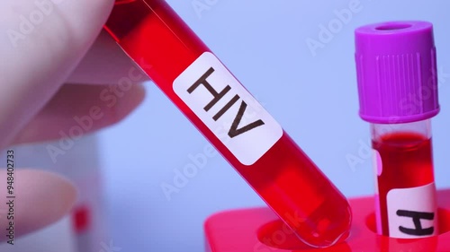 Blood collection tubes HIV test positive results,Medical health concept
