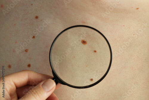 Dermatologist examining patient's birthmarks with magnifying glass, closeup