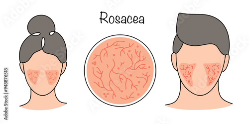 Rosacea