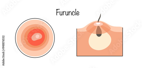 Furuncle