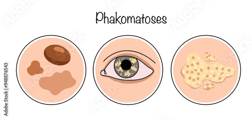 Phakomatoses
