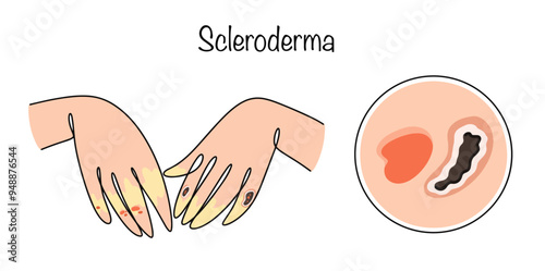 Scleroderma