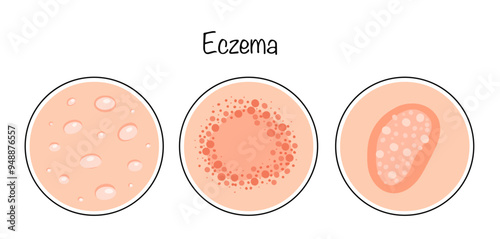 Eczema
