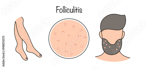 Folliculitis