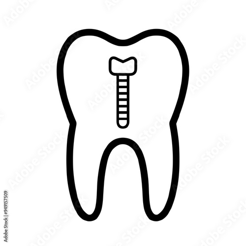 This illustration depicts a simplified diagram of a dental implant, showcasing its placement within a tooth structure for better understanding