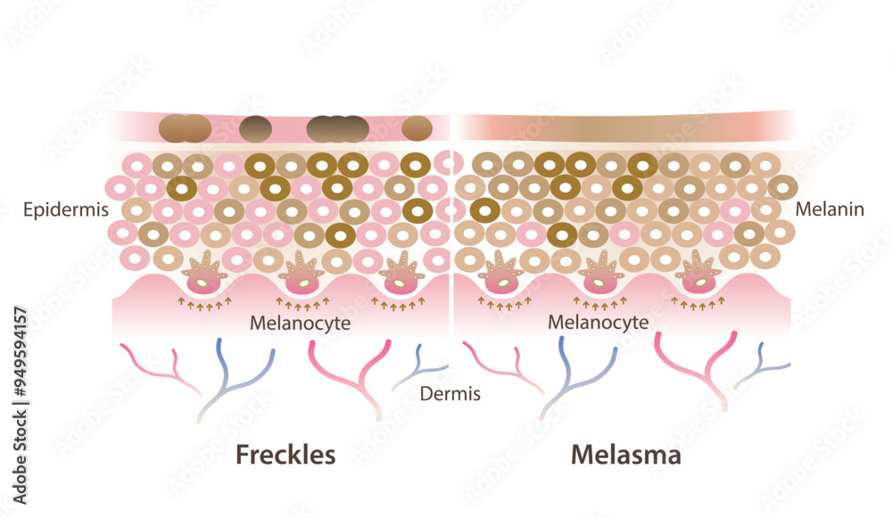 Cross section of freckles and melasma on skin layer vector illustration isolated on white background. Comparison of freckles are small flat brown spots and melasma is brown, blue gray patches on skin.