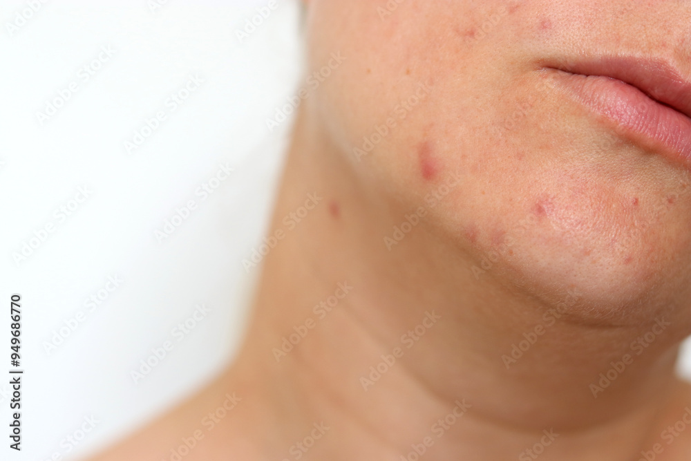 Close up of female face with red problematic acne skin and scars Close up of female face with red problematic acne skin and scars