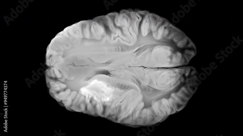 Detailed MRI Scan of Blood-Brain Barrier Permeability in Stroke on Transparent Background