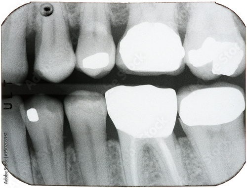 Dental X-rays of teeth in the back of the mouth, brightly showing crowns, root canals, and fillings where cavities and decay had been found. photo