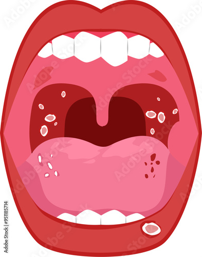 Mouth disease Illustration. Mouth ulcer. Oral cancer.