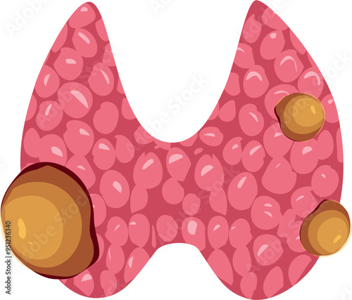 Thyroid disease Illustration. Thyroid cancer. photo