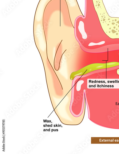 Swimmer's Ear - Otitis Externa
