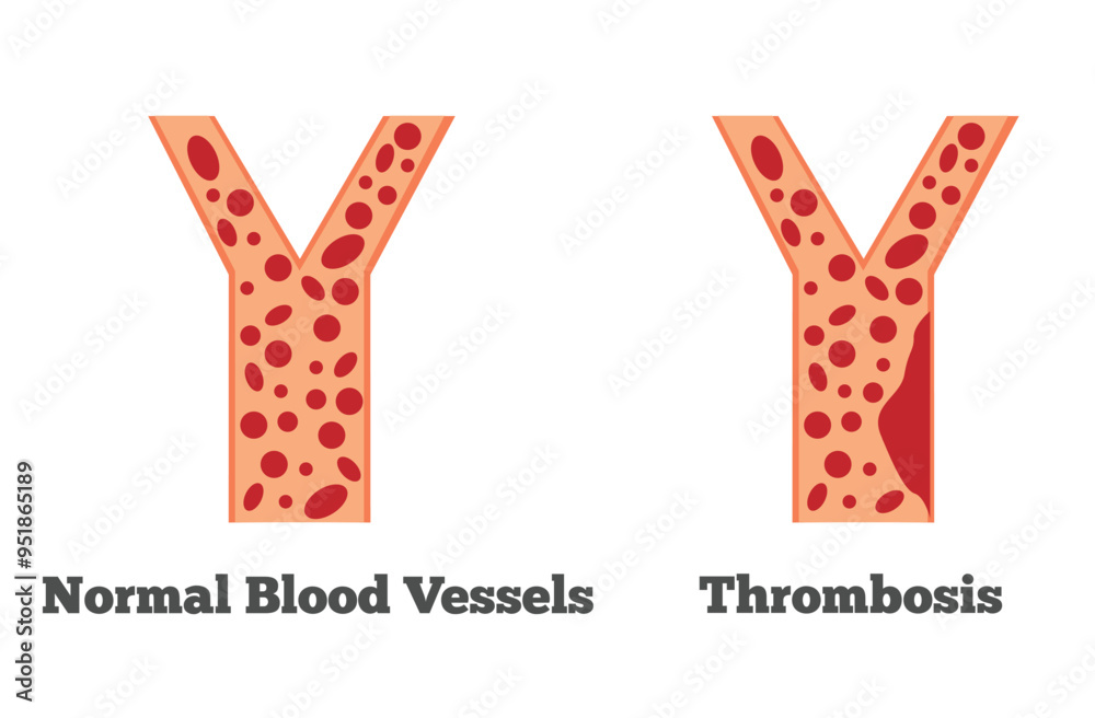 Normal Blood Vessels and Thrombosis. Health care and medicine concept vector Normal Blood Vessels and Thrombosis. Health care and medicine concept vector
