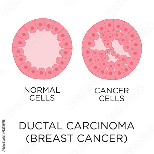 Ductal carcinoma (breast cancer) cells flat style vector illustration in circle layout with type, medical infographic stock illustration

