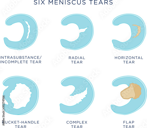 Meniscus tears stock illustration