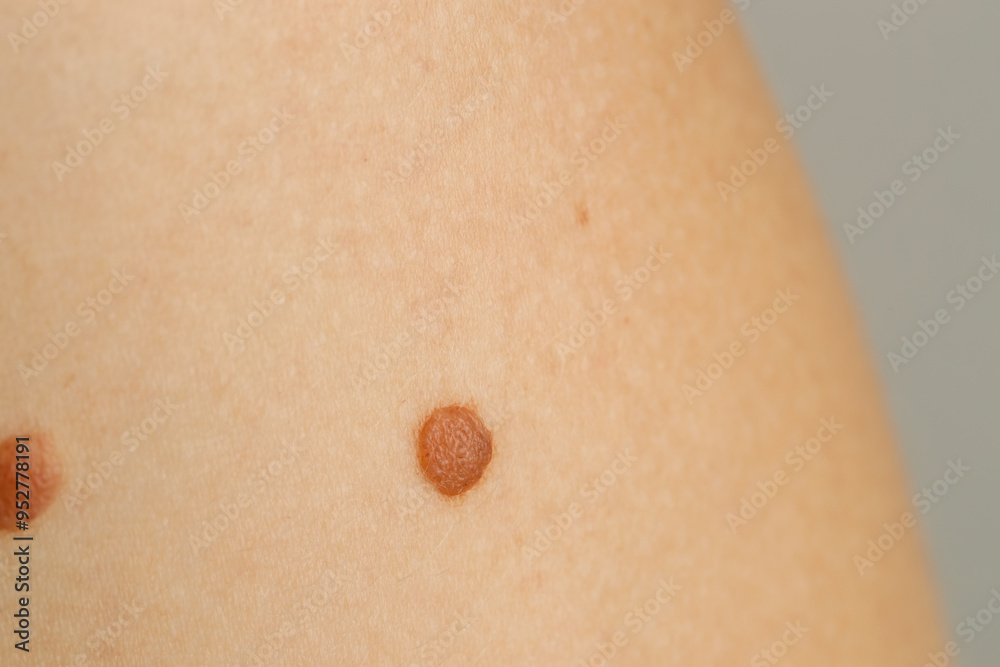Fototapeta premium Woman with moles on her skin against light grey background, closeup
