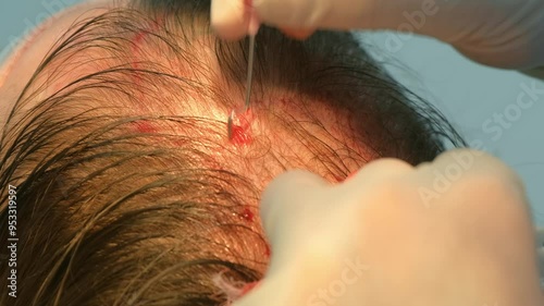 Surgeon punctures head scalp with metal tool to hair transplant operation. Problem of baldness, treatment of alopecia by hair transplantation in clinic hospital. Preparing holes to put hair grafts.
