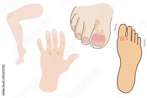 Warts and verrucas are skin growths caused by the human papillomavirus (HPV). Related conditions include plantar warts, genital warts, and common warts. HPV can also lead to cervical,other cancers