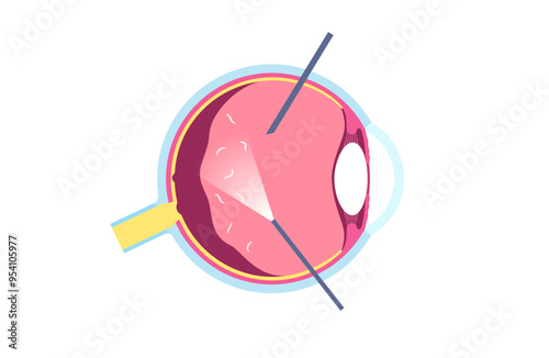 Vitreous hemorrhage poster photo