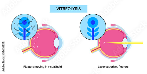 Vitreolysis laser treatment