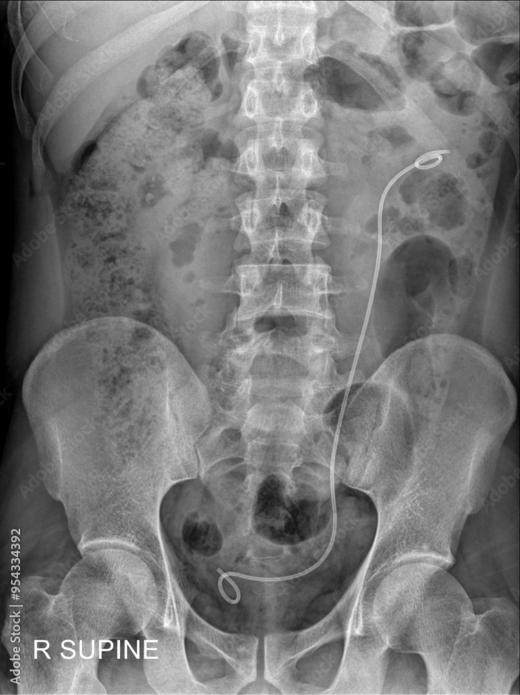 KUB X-ray Imaging with Stent Placement: Precise Radiographic Analysis for Urological Diagnostics KUB X-ray Imaging with Stent Placement: Precise Radiographic Analysis for Urological Diagnostics