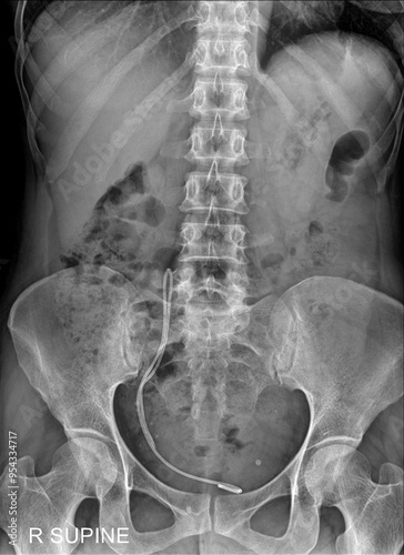 KUB X-ray Revealing Ureteral Stent with Stent Migration photo