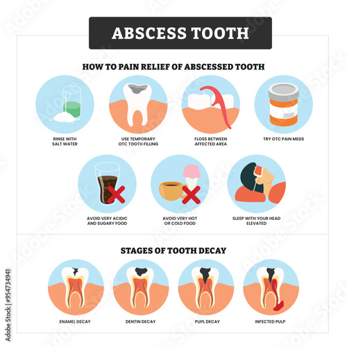 Abscess Tooth infographic medical poster education, labeled relief pain and stages of tooth decay, enamel decay, dentin decay, pulp decay and infected. Gingivitis disease, gum teeth treatment.