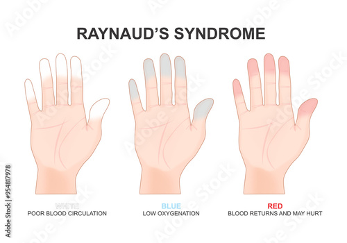 Raynaud's syndrome decreased blood flow to the fingers illustration photo