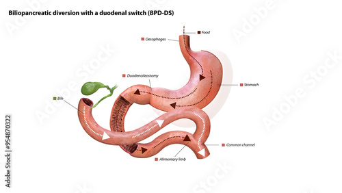 Digestive process after surgery: stomach, food pathway, duodenoileostomy, bile flow, alimentary limb, common channel, and ascending colon, 3d graphic