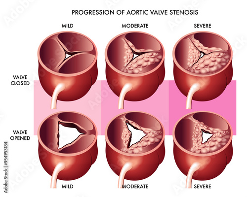 Medical illustration showing the progression of aortic valve stenosis, both open and closed with annotations.