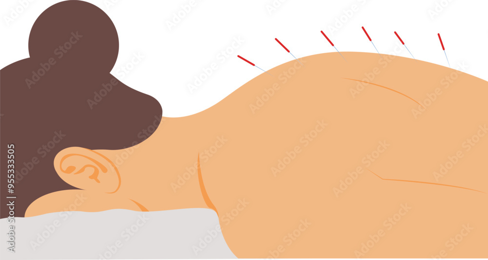woman with acupuncture needles, Process of acupuncture and needle therapy woman with acupuncture needles, Process of acupuncture and needle therapy