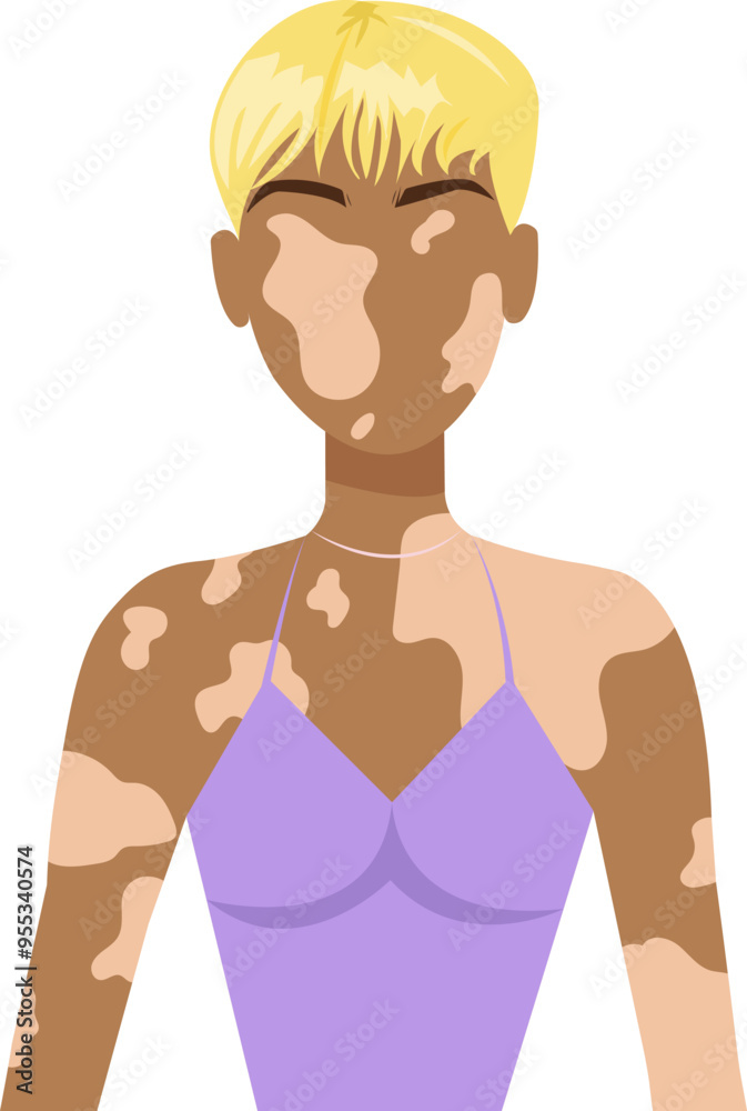 Fototapeta premium Lovely woman with vitiligo. Concepts of body positivity in people suffering from dermatological illness or vitiligo syndrome. Support people with chronic skin disorder. Vector illustration 