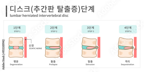추간판탈출증 단계 _ 메디컬 일러스트_허리디스크 일러스트