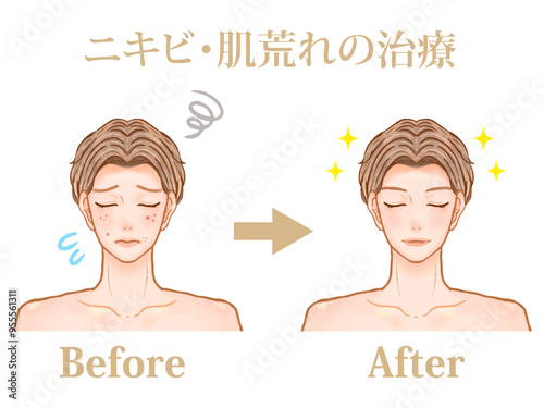 美容皮膚科でニキビ治療した大人男性のビフォーアフターのイラスト素材