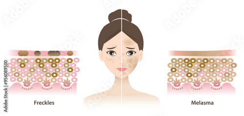 Infographic of freckles and melasma skin on woman face vector illustration. Comparison of hyperpigmentation, small flat brown spots and brown, blue gray patches on skin layer. Skin care concept.