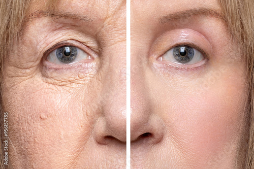 Fotografi Lower and upper eyelid blepharoplasty