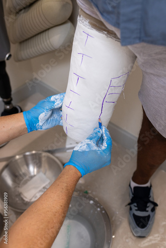 Creating custom prosthetic leg, technician marking plaster mold for patient