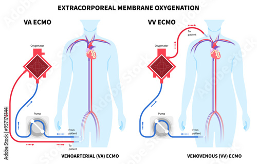 Life support system with the Extracorporeal Membrane Oxygenation or ECMO for Respiratory failure and illness patient