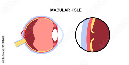 Macular hole disease photo