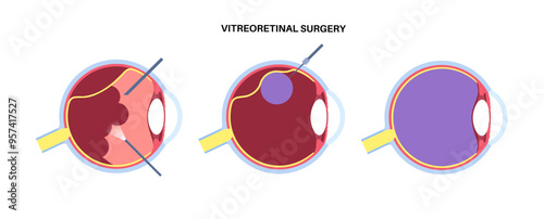 Vitreoretinal surgery poster