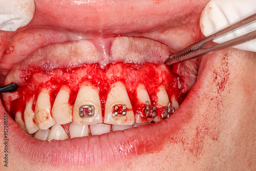 Gummy smile clinical case with orthodontic brackets. Second surgery step: gingival retraction with dental strippers instruments. Surgical detachment, exposing the alveolar bone and contour reshaping. 
