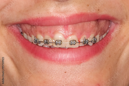 Gummy smile clinical case with orthodontic brackets and metallic wire. Patient shows an uneven gum line on frontal maxillary central incisors before gum contouring reshaping surgery.